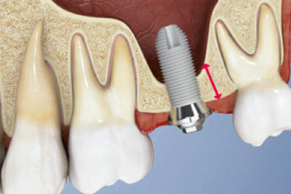 ricostruzione-chirurgica-dente-mestre-prima