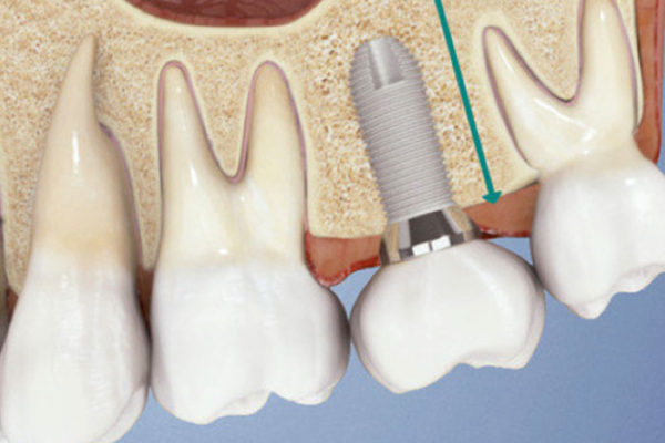 ricostruzione-chirurgica-dente-mestre-seconda